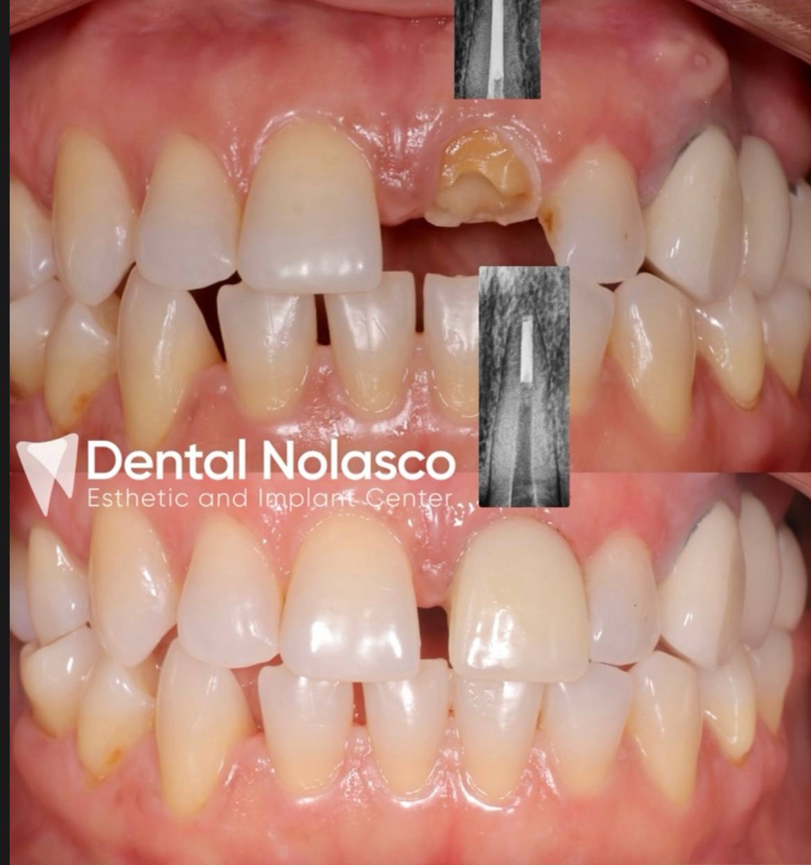 Antes y Después - Caso 7